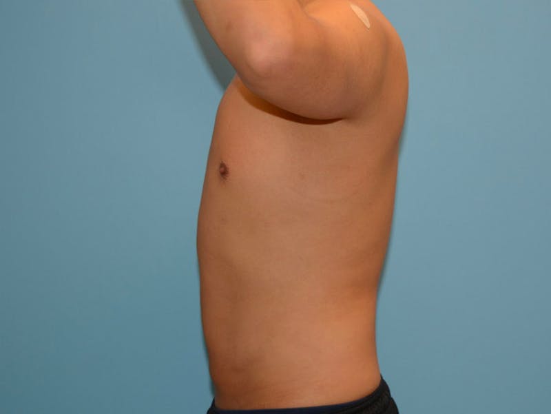 Male Liposuction Before & After Gallery - Patient 12898851 - Image 6