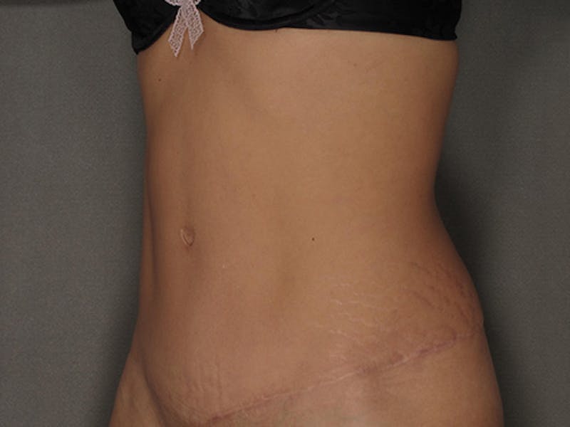 Tummy Tuck Before & After Gallery - Patient 12898852 - Image 10