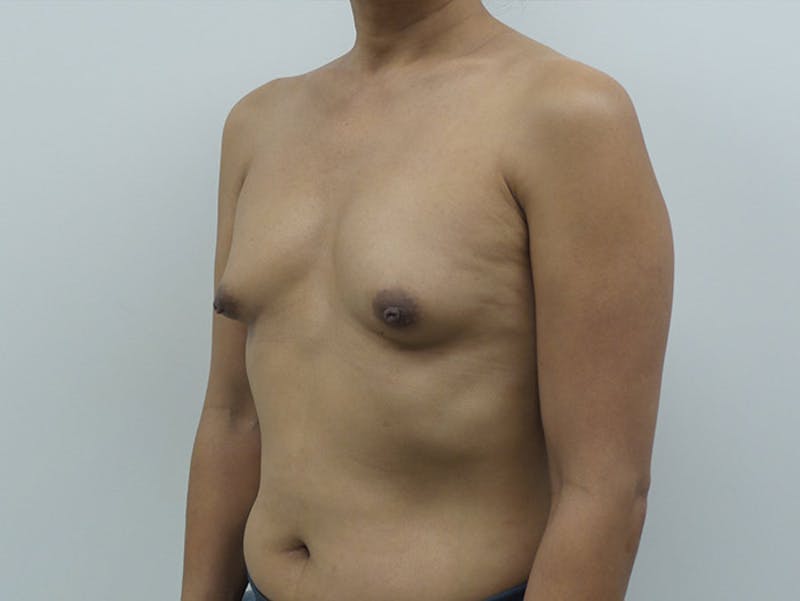 Transgender Breast Augmentation Before & After Gallery - Patient 12898859 - Image 3