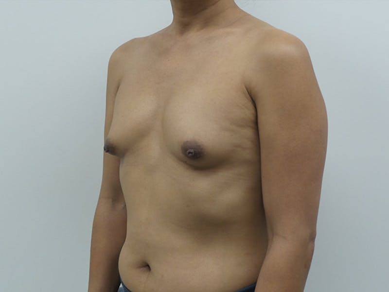 Transgender Breast Augmentation Before & After Gallery - Patient 12898859 - Image 3