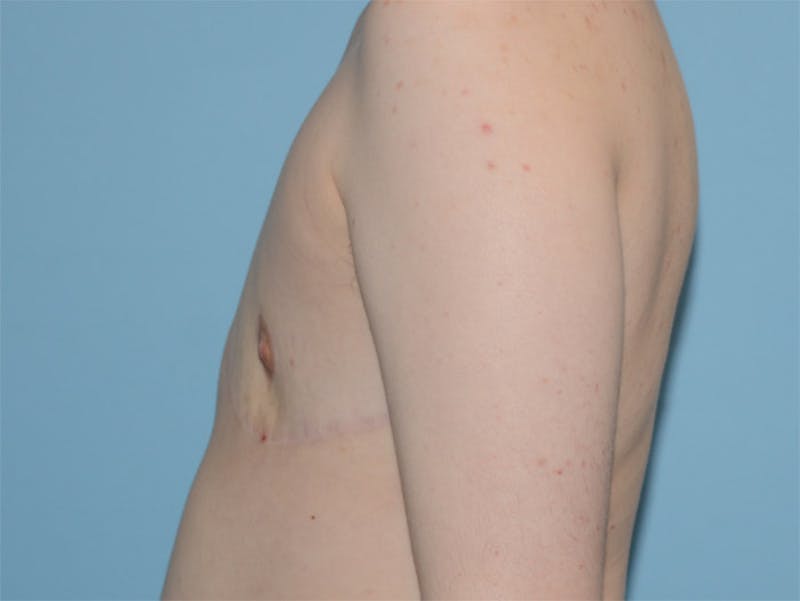 Top Surgery Before & After Gallery - Patient 12898856 - Image 4