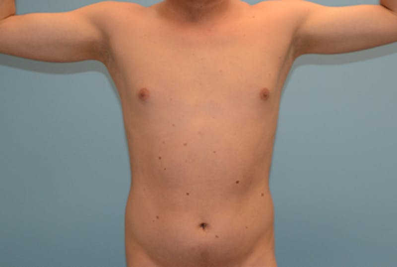 Male Liposuction Before & After Gallery - Patient 12898862 - Image 1