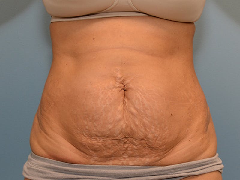 Tummy Tuck Before & After Gallery - Patient 12898858 - Image 1