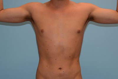 Male Liposuction Before & After Gallery - Patient 12898862 - Image 2