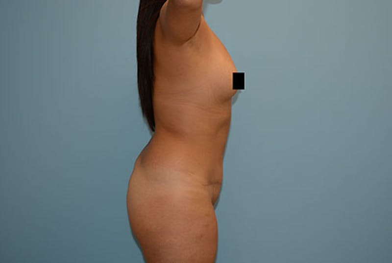 Liposuction Before & After Gallery - Patient 12898857 - Image 5