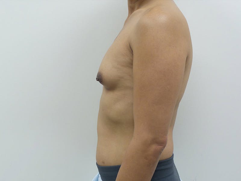 Transgender Breast Augmentation Before & After Gallery - Patient 12898859 - Image 5