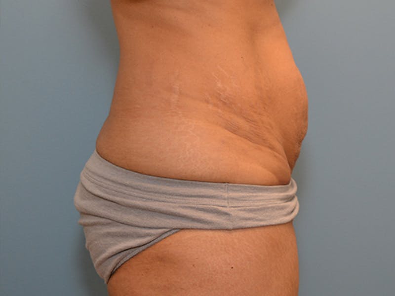 Tummy Tuck Before & After Gallery - Patient 12898858 - Image 3