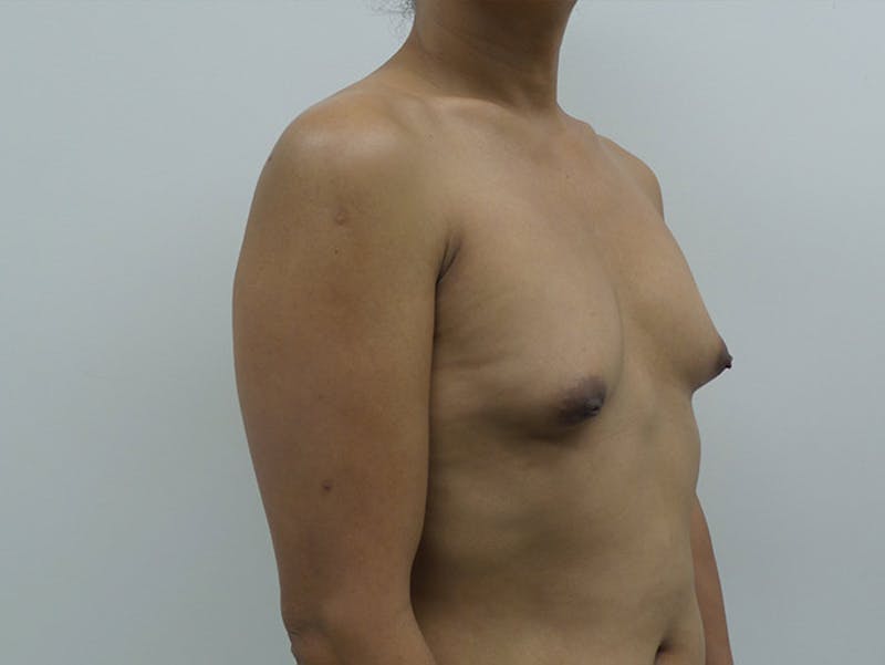 Transgender Breast Augmentation Before & After Gallery - Patient 12898859 - Image 7
