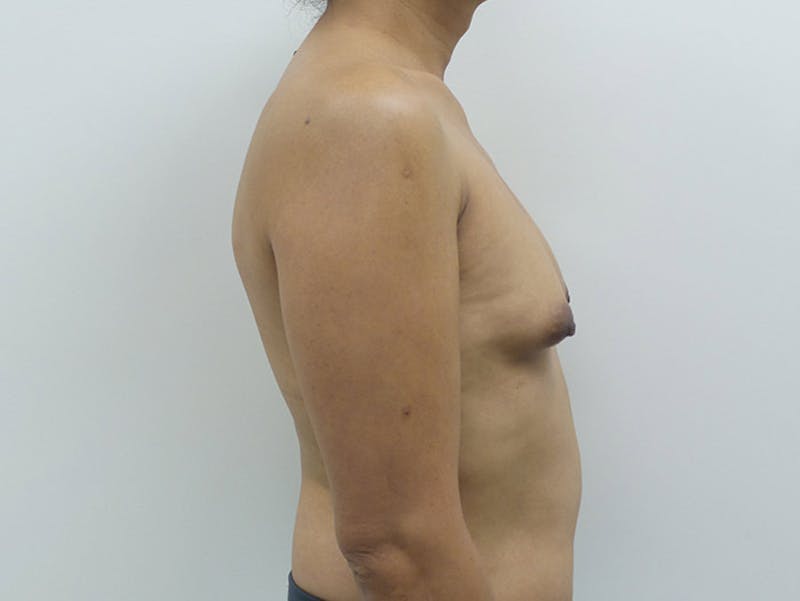 Transgender Breast Augmentation Before & After Gallery - Patient 12898859 - Image 9