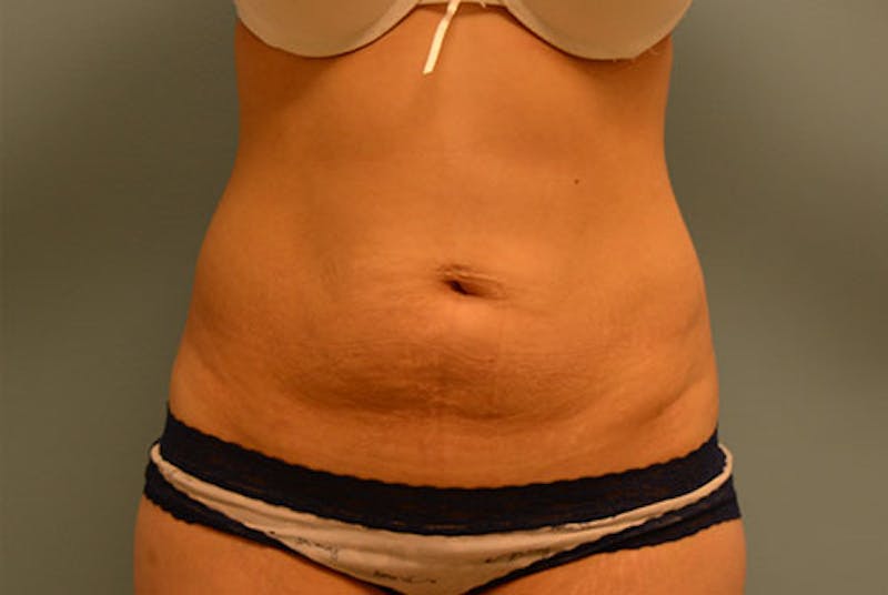 Tummy Tuck Before & After Gallery - Patient 12898864 - Image 1