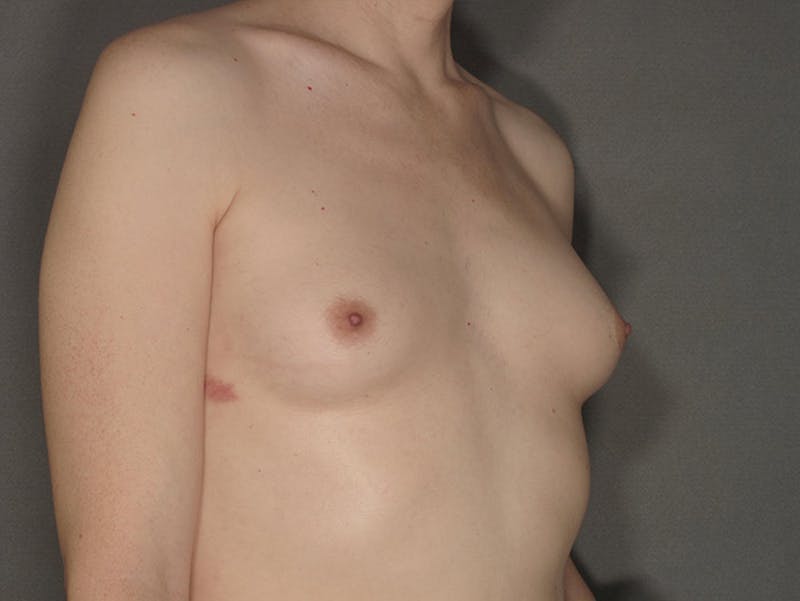 Transgender Breast Augmentation Before & After Gallery - Patient 12898878 - Image 3