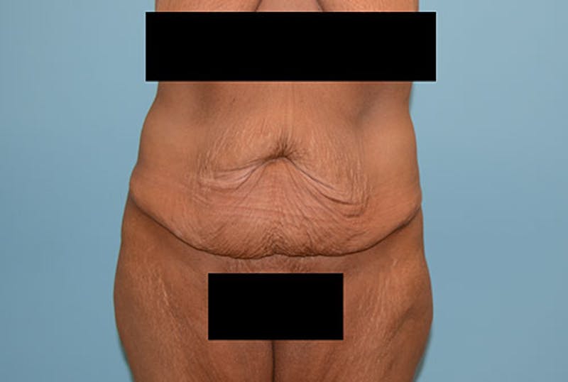 Tummy Tuck Gallery - Patient 12898873 - Image 1