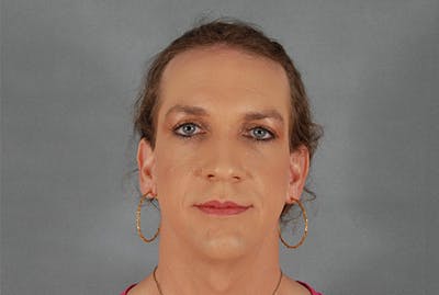 Facial Feminization Before & After Gallery - Patient 12898876 - Image 1