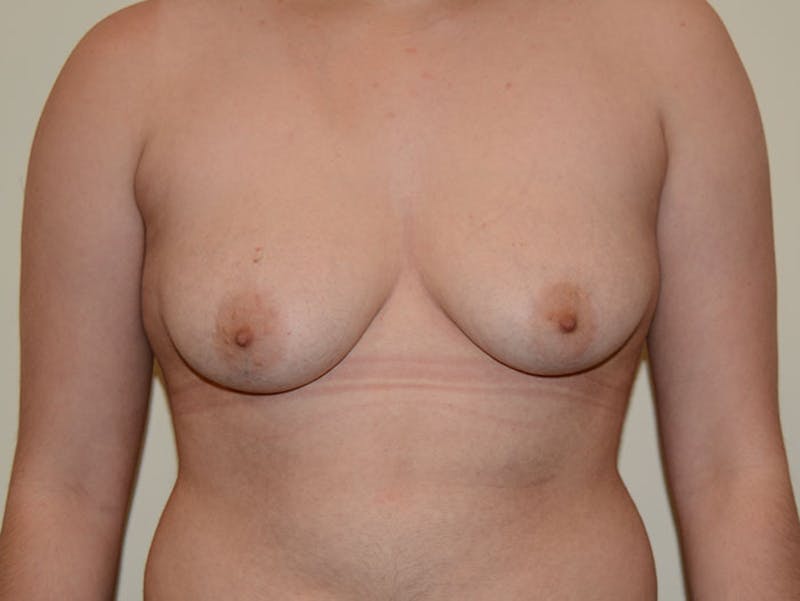 Top Surgery Before & After Gallery - Patient 12898875 - Image 1