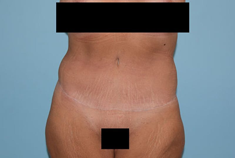 Tummy Tuck Gallery - Patient 12898873 - Image 2