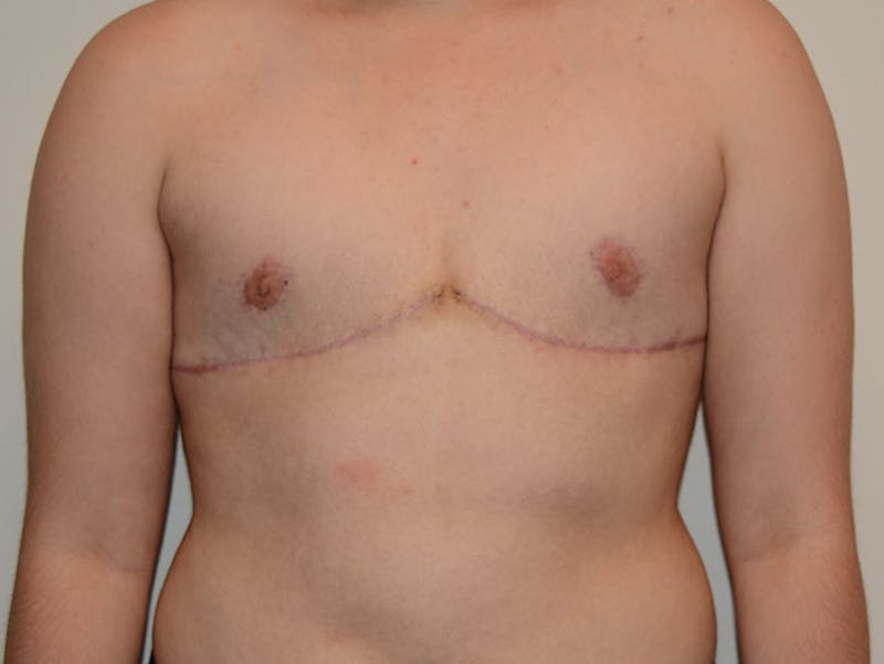 Top Surgery Before & After Gallery - Patient 12898875 - Image 2