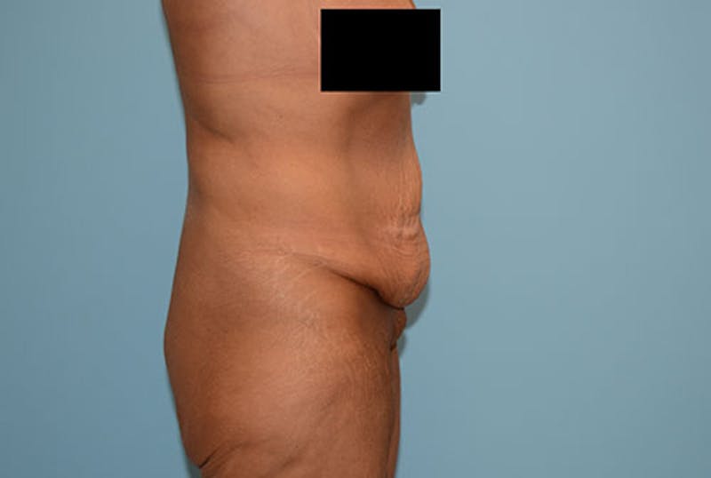 Tummy Tuck Before & After Gallery - Patient 12898873 - Image 3