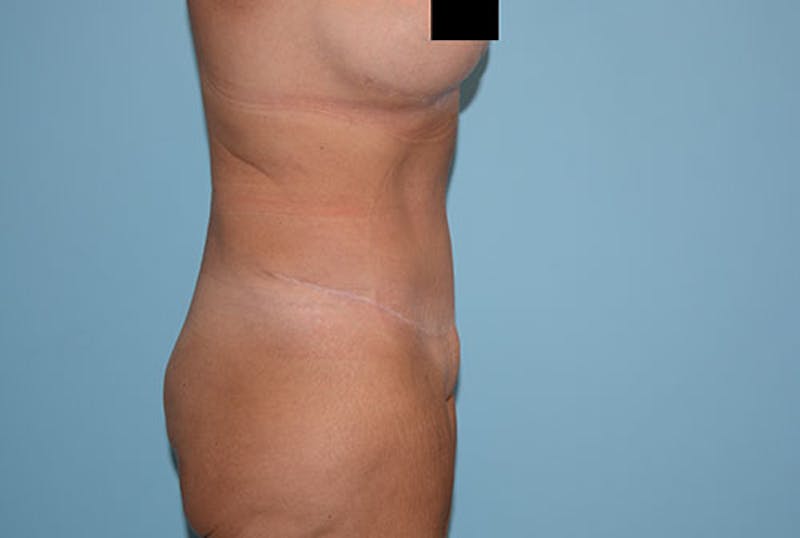 Tummy Tuck Before & After Gallery - Patient 12898873 - Image 4