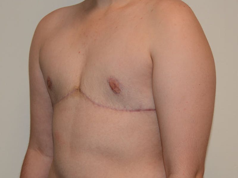 Top Surgery Before & After Gallery - Patient 12898875 - Image 4