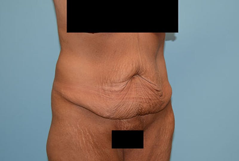 Tummy Tuck Gallery - Patient 12898873 - Image 5