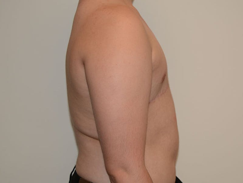 Top Surgery Before & After Gallery - Patient 12898875 - Image 6