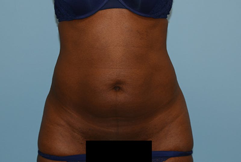 Liposuction Before & After Gallery - Patient 12898890 - Image 1