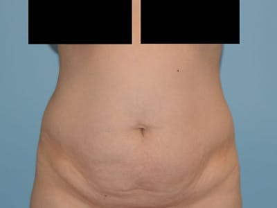 Tummy Tuck Before & After Gallery - Patient 12898879 - Image 1