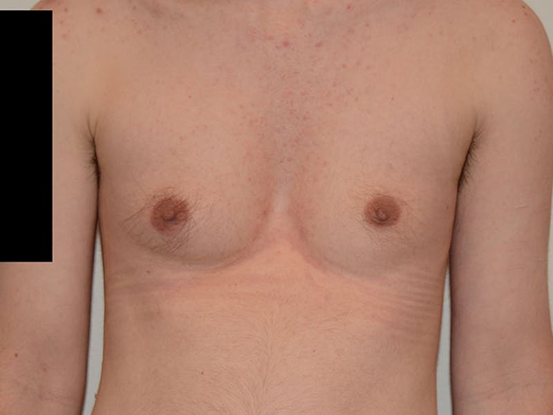Top Surgery Before & After Gallery - Patient 12898889 - Image 1