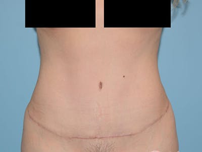 Tummy Tuck Before & After Gallery - Patient 12898879 - Image 2