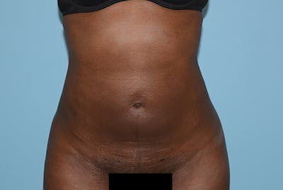 Liposuction Before & After Gallery - Patient 12898890 - Image 2