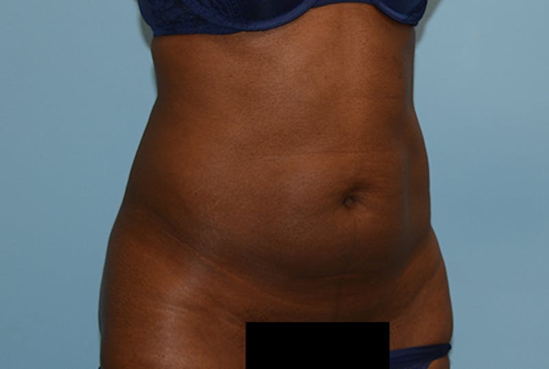 Liposuction Before & After Gallery - Patient 12898890 - Image 3