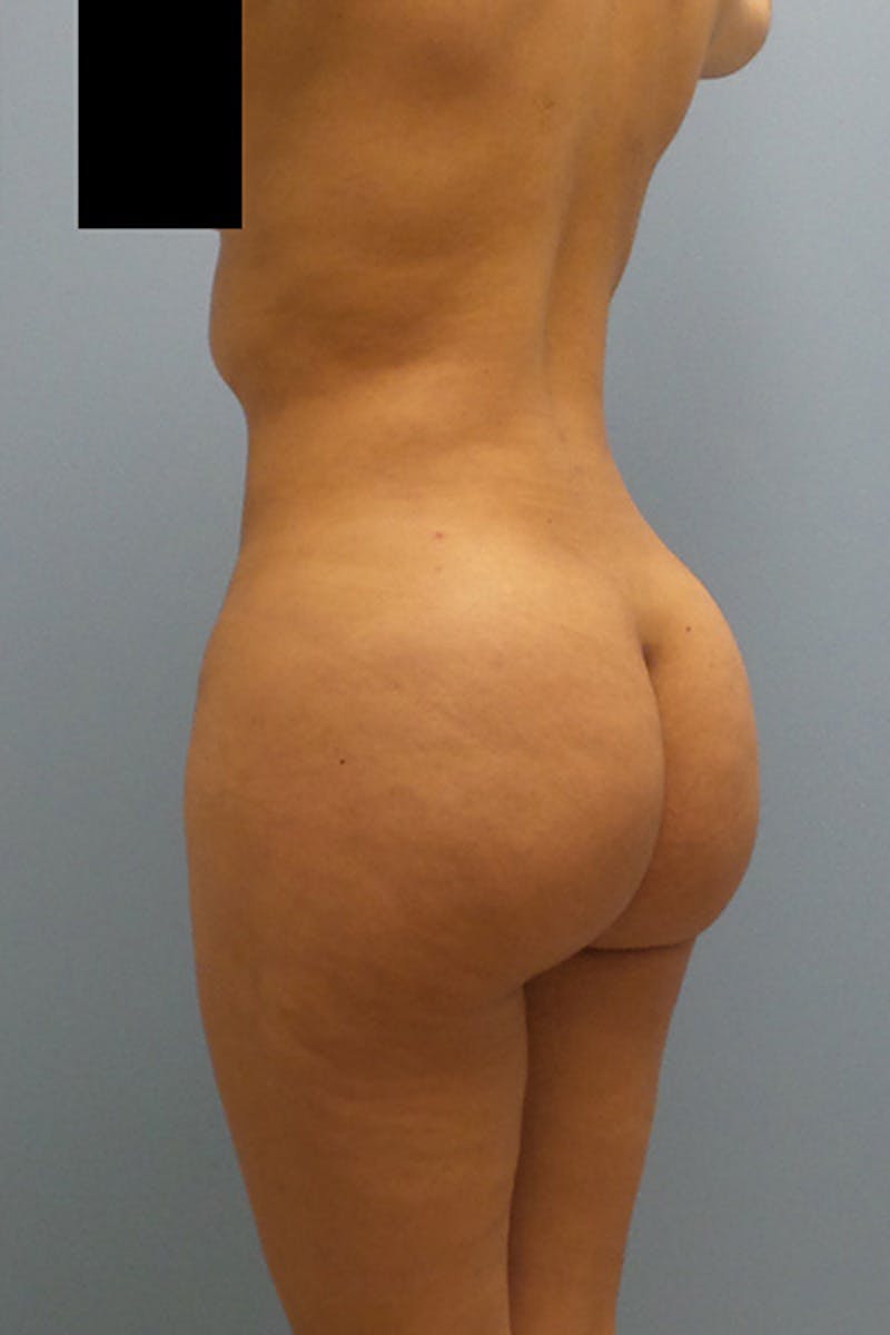 Brazilian Butt Lift Before & After Gallery - Patient 12898883 - Image 6