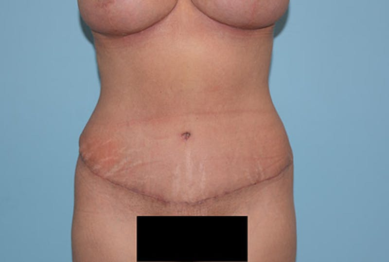 Tummy Tuck Before & After Gallery - Patient 12898888 - Image 2