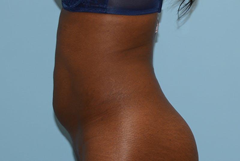 Liposuction Before & After Gallery - Patient 12898890 - Image 5
