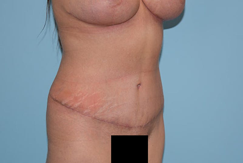 Tummy Tuck Before & After Gallery - Patient 12898888 - Image 4