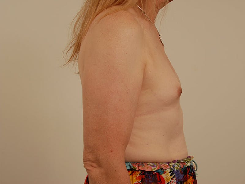 Transgender Breast Augmentation Before & After Gallery - Patient 12898891 - Image 5