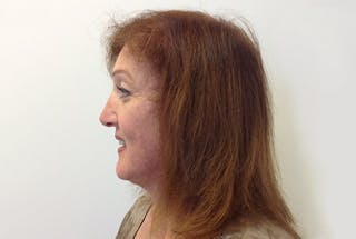 Facial Feminization Before & After Gallery - Patient 12898896 - Image 4