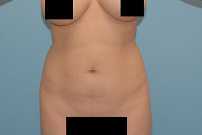 Liposuction Before & After Gallery - Patient 12898898 - Image 1