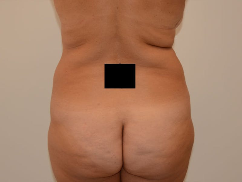 Tummy Tuck Before & After Gallery - Patient 12898894 - Image 3