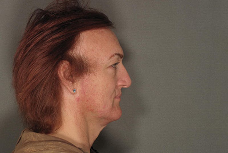 Facial Feminization Before & After Gallery - Patient 12898896 - Image 5