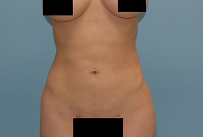 Liposuction Before & After Gallery - Patient 12898898 - Image 2