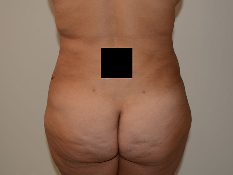 Tummy Tuck Gallery - Patient 12898894 - Image 4