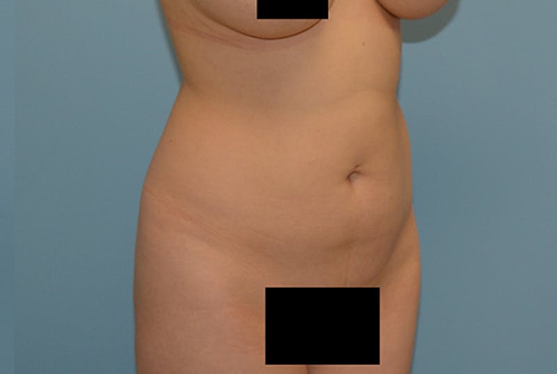 Liposuction Before & After Gallery - Patient 12898898 - Image 3