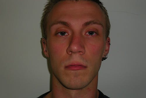 Facial Feminization Before & After Gallery - Patient 12898900 - Image 1