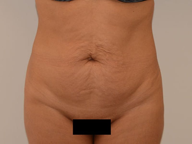 Tummy Tuck Before & After Gallery - Patient 12898902 - Image 1