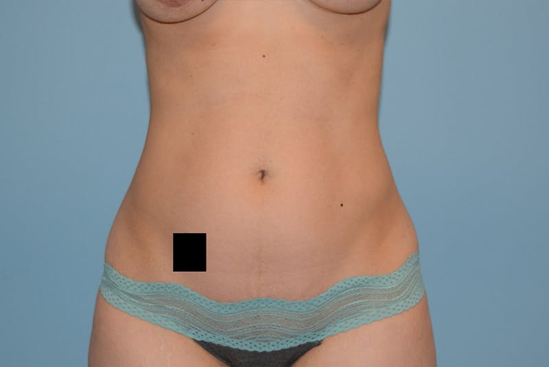 Liposuction Before & After Gallery - Patient 12898904 - Image 1