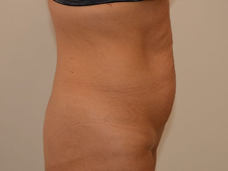 Tummy Tuck Before & After Gallery - Patient 12898902 - Image 3