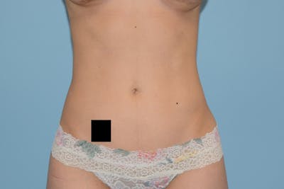 Liposuction Before & After Gallery - Patient 12898904 - Image 2
