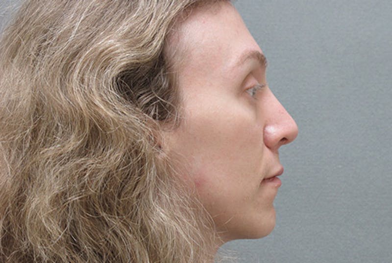 Facial Feminization Before & After Gallery - Patient 12898900 - Image 6
