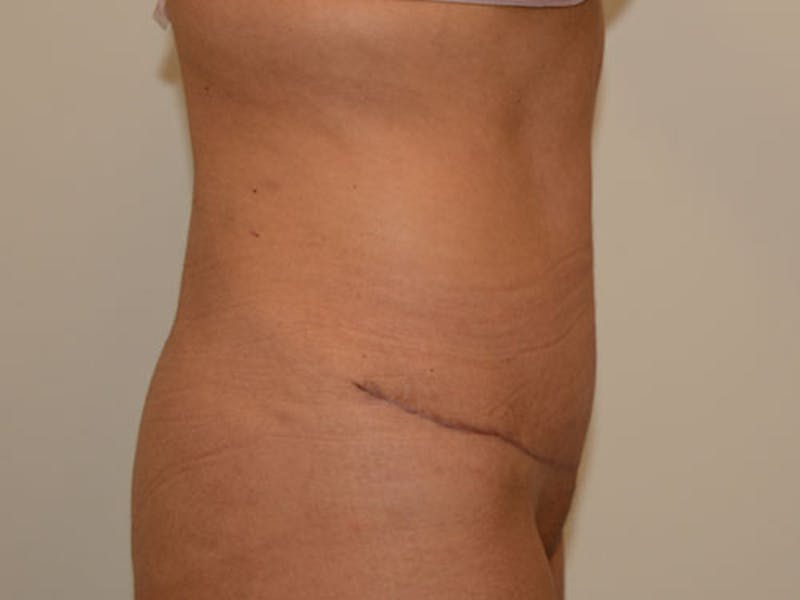 Tummy Tuck Before & After Gallery - Patient 12898902 - Image 4